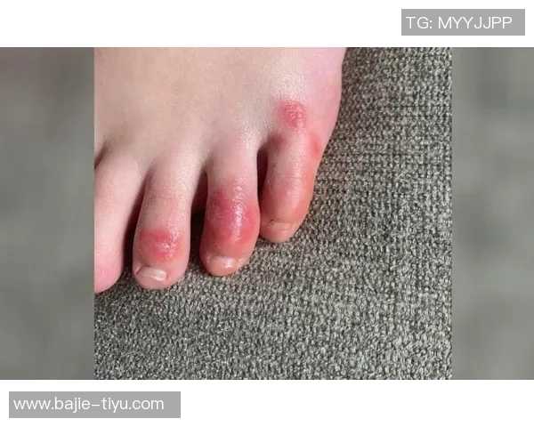 恩昆库脚趾疼痛基本消失或将入选对比萨比赛名单 恩昆库脚趾疼痛基本消失或将入选对比萨比赛名单